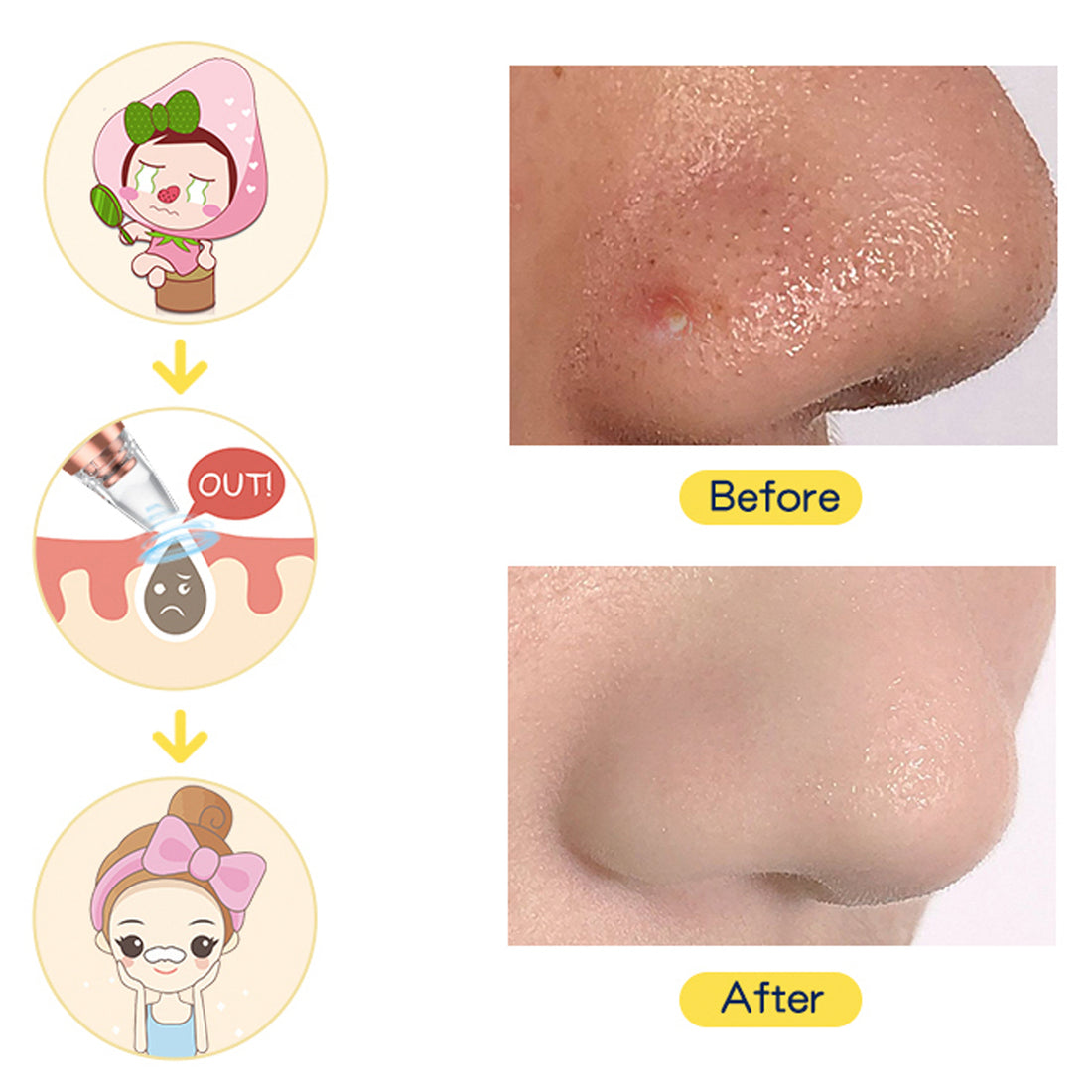 Multifunctional Facial Pore Cleaner Face Deep Cleaner Pore Acne Pimple Removal Vacuum Facial Vacuum Pore Cleaner